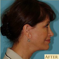 Facelift Before & After Patient #396