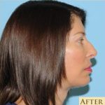 Facelift Before & After Patient #410