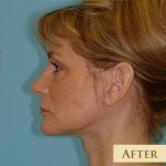 Facelift Before & After Patient #417