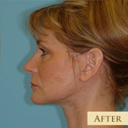Facelift Before & After Patient #417