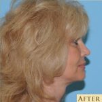 Facelift Before & After Patient #424