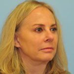 Facelift Before & After Patient #445