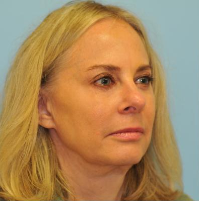Facelift Before & After Patient #445