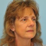 Facelift Before & After Patient #452
