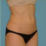 Liposuction Before & After Patient #473