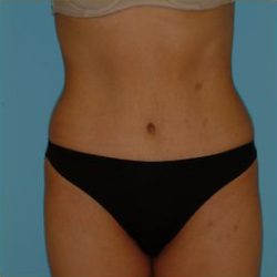 Abdominoplasty Before & After Patient #108