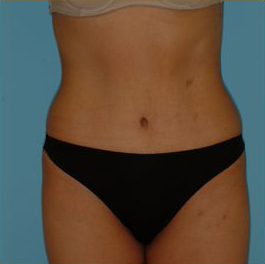 Abdominoplasty Before & After Patient #108