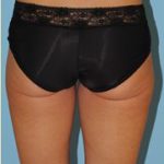 Liposuction Before & After Patient #487