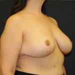 Explanation with Mastopexy Before & After Patient #527