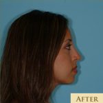Rhinoplasty Before & After Patient #534