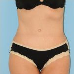 Abdominoplasty Before & After Patient #115