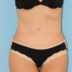 Abdominoplasty Before & After Patient #115