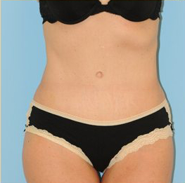 Abdominoplasty Before & After Patient #115
