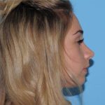 Rhinoplasty Before & After Patient #541