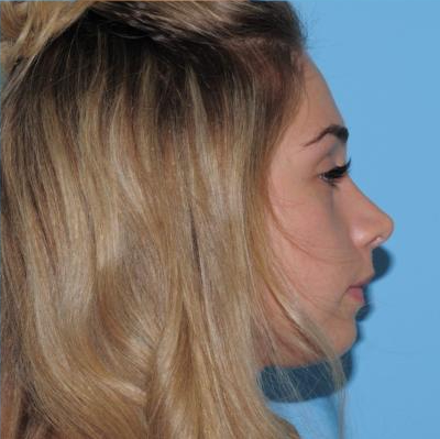 Rhinoplasty Before & After Patient #541