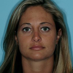 Rhinoplasty Before & After Patient #560