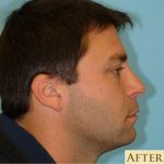 Rhinoplasty Before & After Patient #602