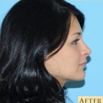Rhinoplasty Before & After Patient #609