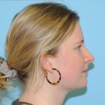 Rhinoplasty Before & After Patient #616