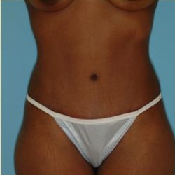 Abdominoplasty Before & After Patient #122