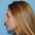 Rhinoplasty Before & After Patient #630