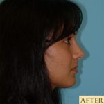 Rhinoplasty Before & After Patient #637