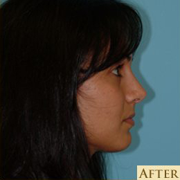 Rhinoplasty Before & After Patient #637