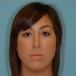 Rhinoplasty Before & After Patient #644