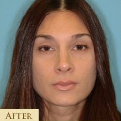Rhinoplasty Before & After Patient #658