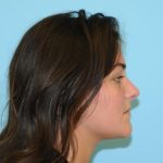 Rhinoplasty Before & After Patient #665