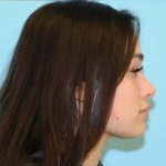 Rhinoplasty Before & After Patient #672