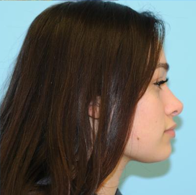Rhinoplasty Before & After Patient #672