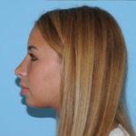Rhinoplasty Before & After Patient #679