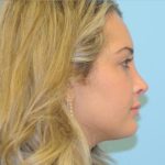 Rhinoplasty Before & After Patient #686