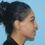 Rhinoplasty Before & After Patient #693