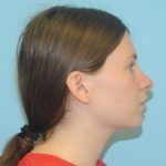 Rhinoplasty Before & After Patient #700