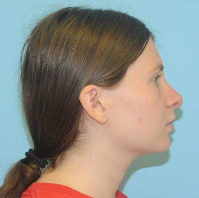 Rhinoplasty Before & After Patient #700