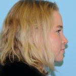 Rhinoplasty Before & After Patient #707