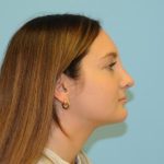 Rhinoplasty Before & After Patient #714