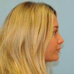 Rhinoplasty Before & After Patient #721