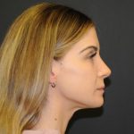 Rhinoplasty Before & After Patient #728