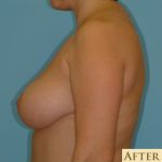 Mastopexy Before & After Patient #735