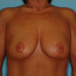 Mastopexy Before & After Patient #756