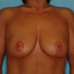 Mastopexy Before & After Patient #756