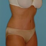 Abdominoplasty Before & After Patient #73