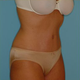 Abdominoplasty Before & After Patient #73