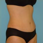 Abdominoplasty Before & After Patient #136