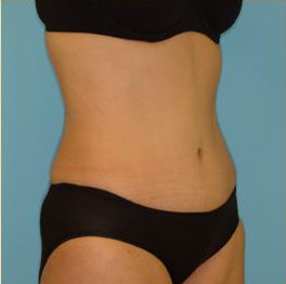 Abdominoplasty Before & After Patient #136