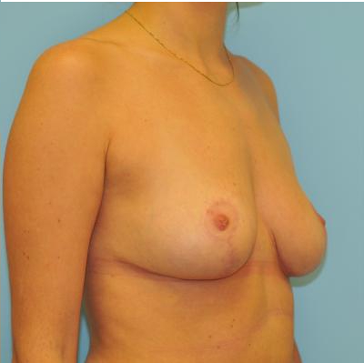 Mastopexy Before & After Patient #791