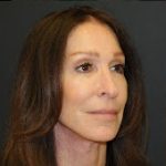 Facelift Before & After Patient #326